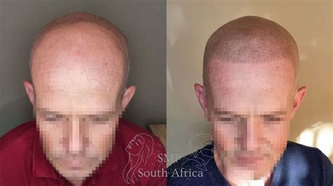 scalp micropigmentation sa|SMP .